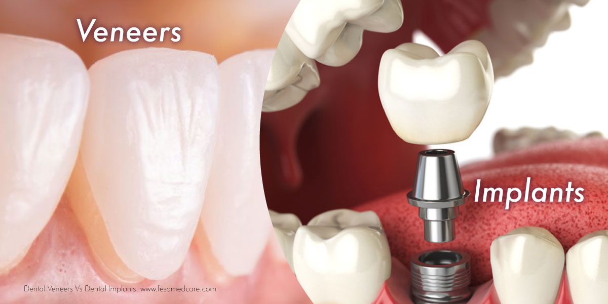 Dental Implants Vs Veneers Fesamedcare Consultation with Doctors